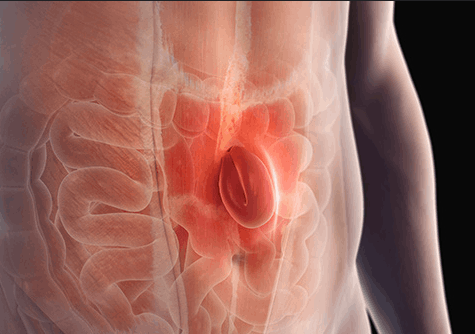 cirugia minima invasion hernias guadalajara