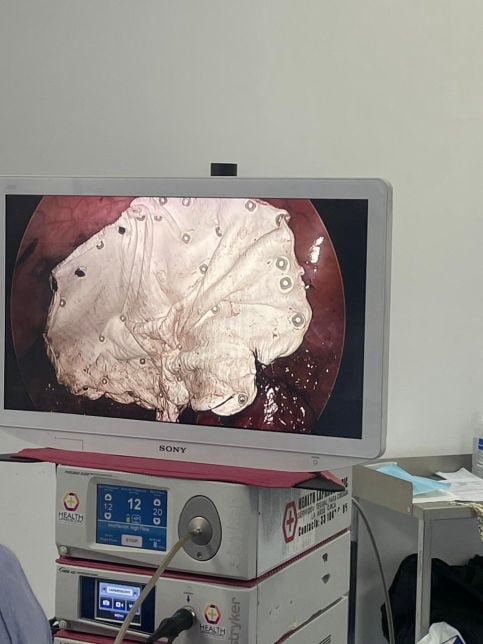 cirugia hernia ventral guadalajara